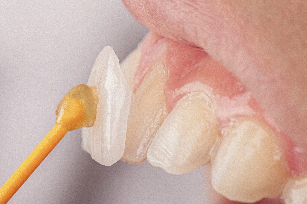 Teeth Denture
