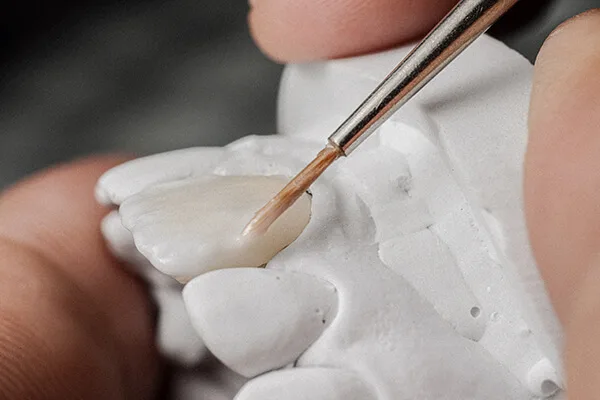 Cosmetic Veneers