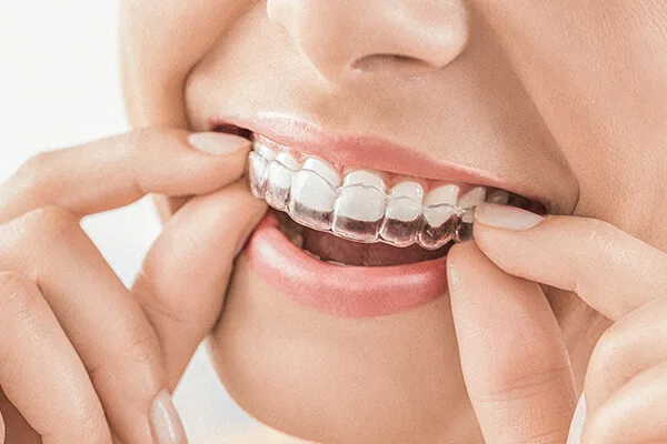 Invisalign