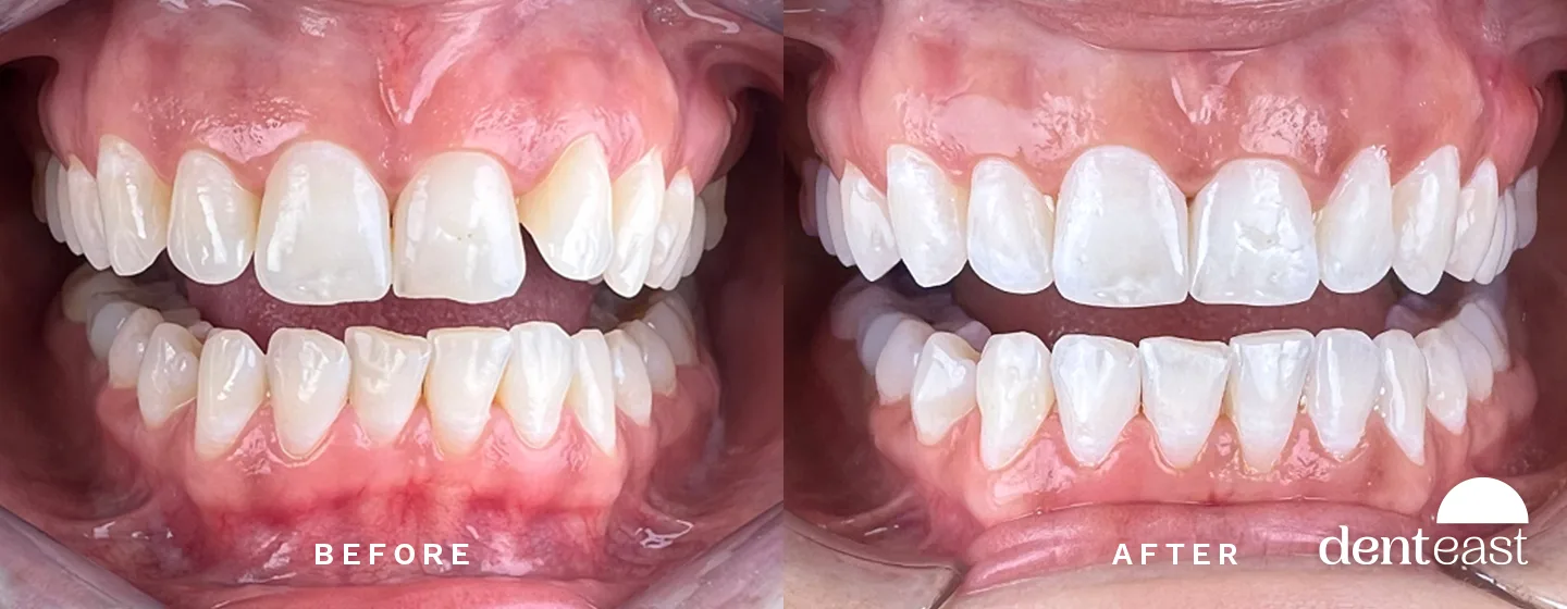 Before and After 0