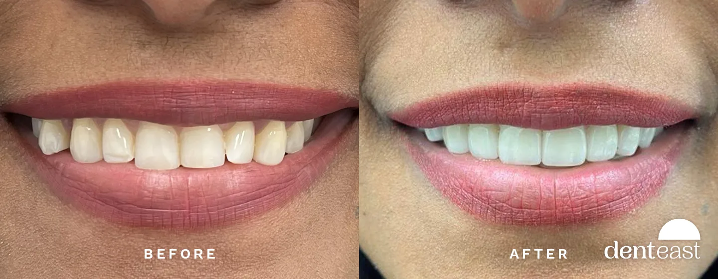 Before and After 1