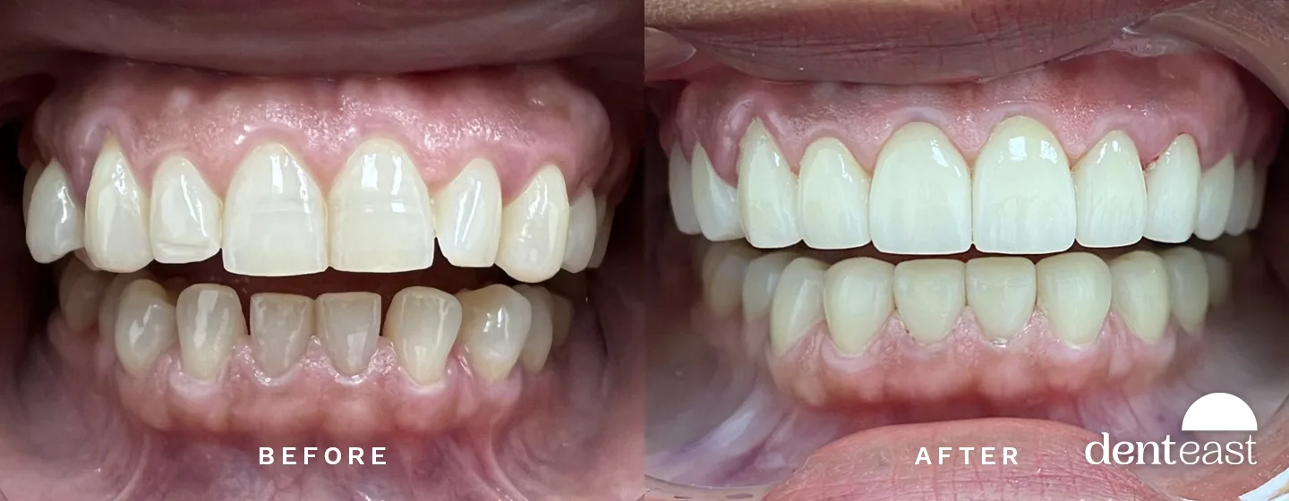 Before and After 2
