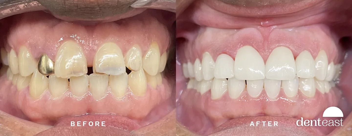 Before and After 3