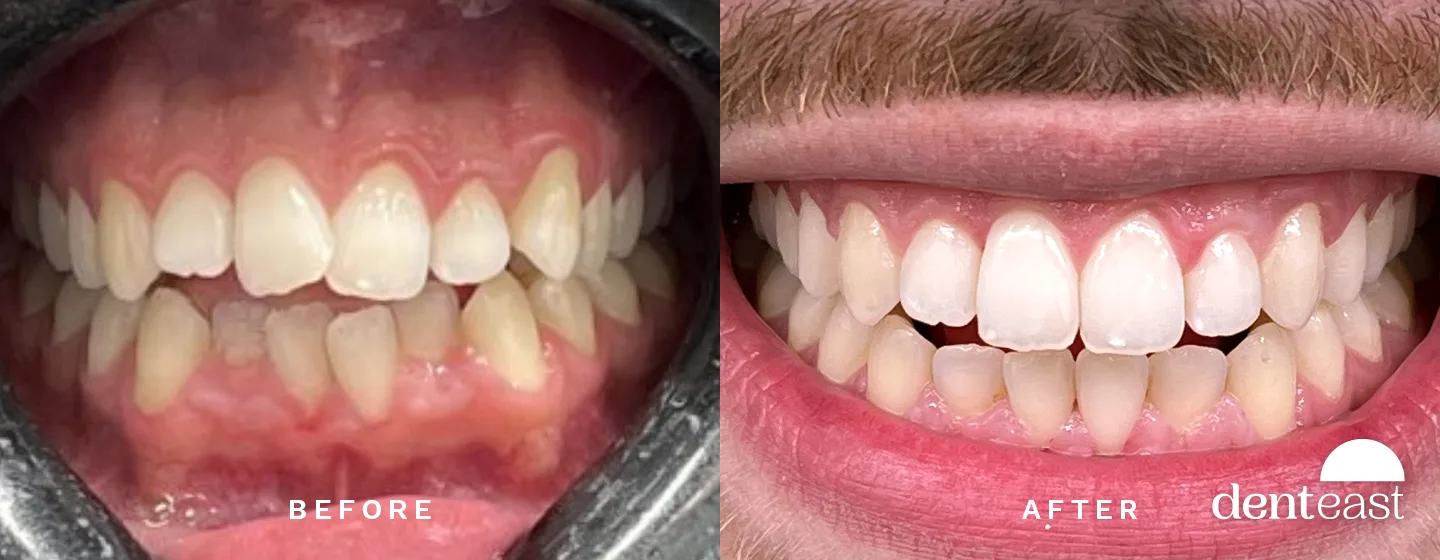 Before and After 5