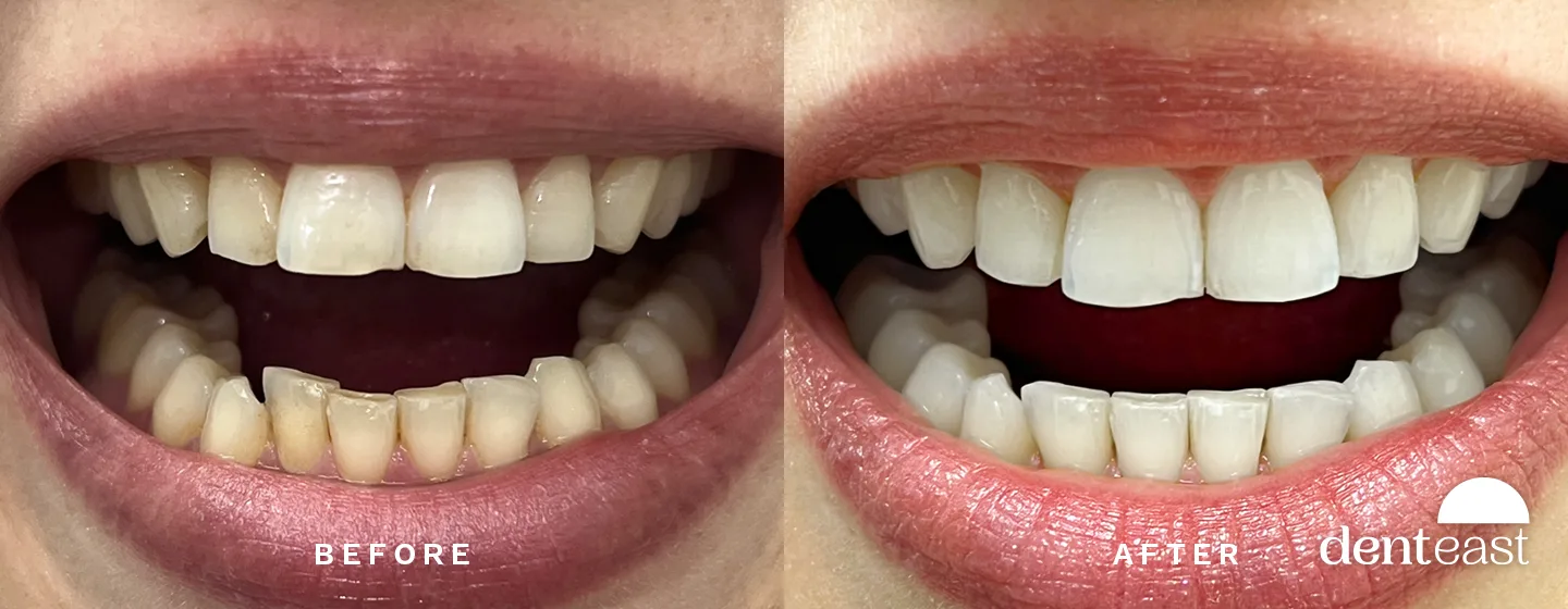 Before and After 6