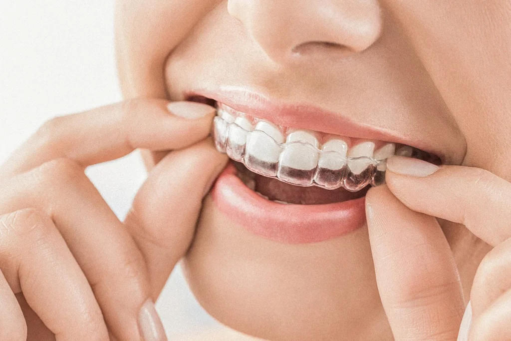 Invisalign® at Denteast, Fort Lauderdale