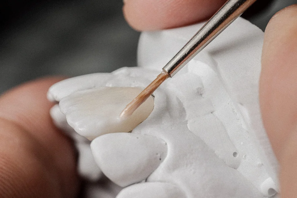 Veneers at Denteast, Fort Lauderdale