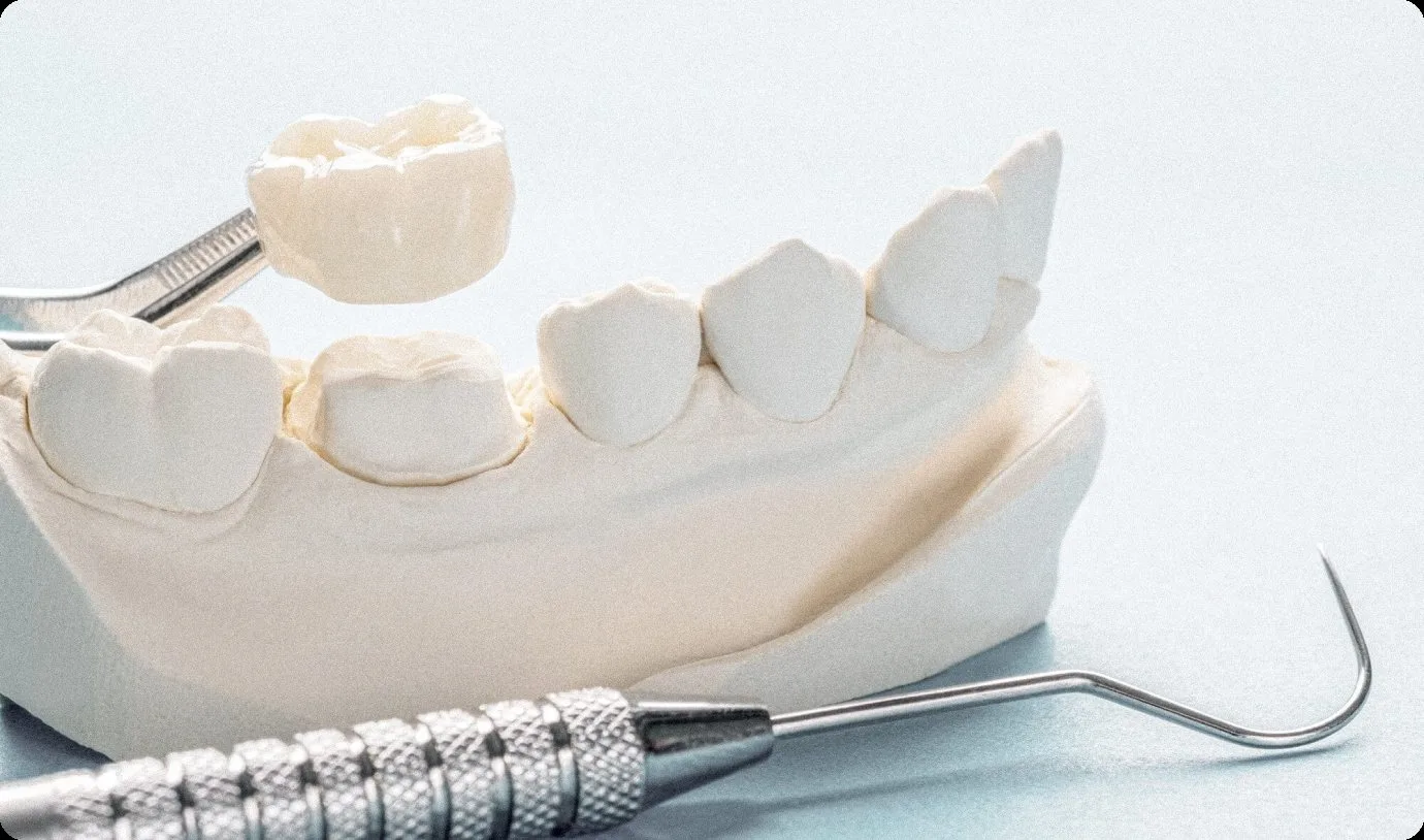 Dental crown on a model of teeth