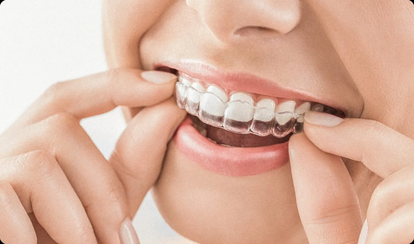 Patient placing a clear Invisalign aligner