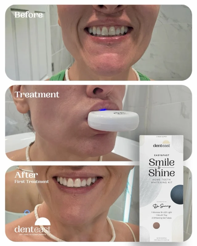 A little behind-the-scenes whitening moment. ✨ Smile & Shine in action!