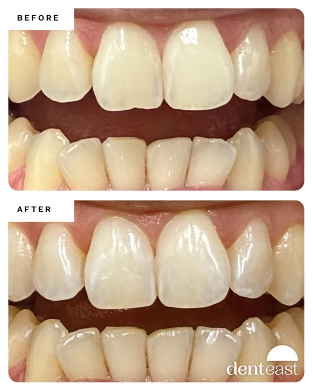 Repairing a Chip on the Edge of a Front Tooth. 👌
