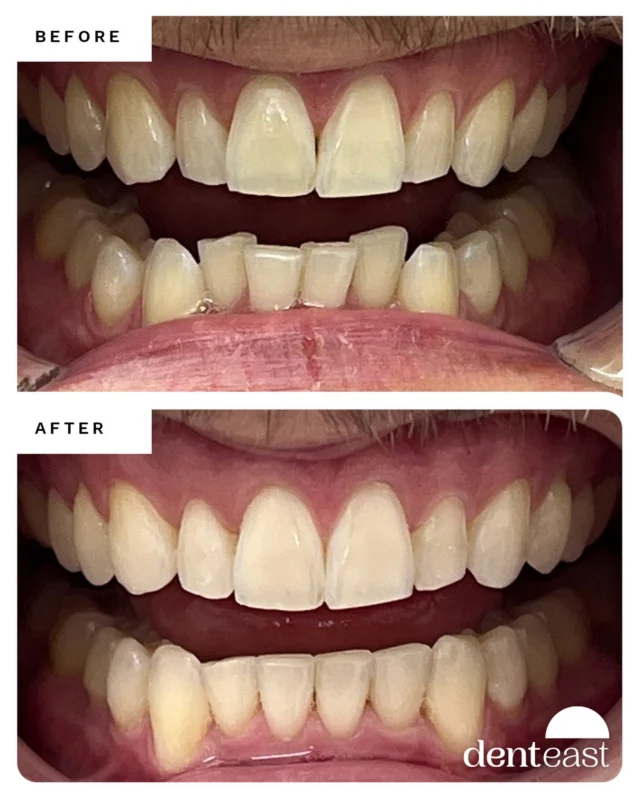 New Invisalign Case. Happy Monday! We’re general and cosmetic dentist in Fort Lauderdale. We serve people from East Coast Florida, Wast Coas…